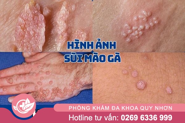 Hình ảnh sùi mào gà