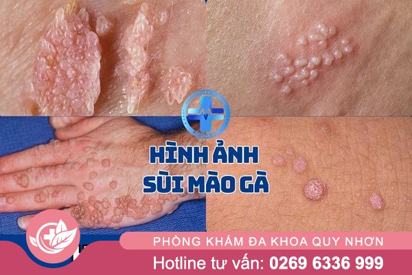 Hình ảnh sùi mào gà