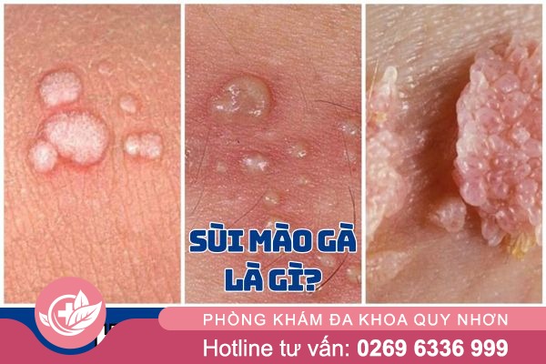 Sùi mào gà là gì?