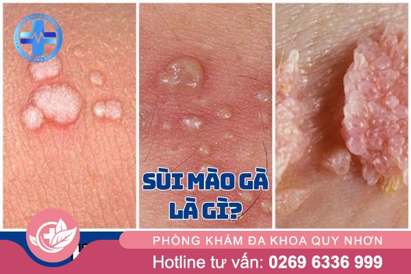 Sùi mào gà là gì?