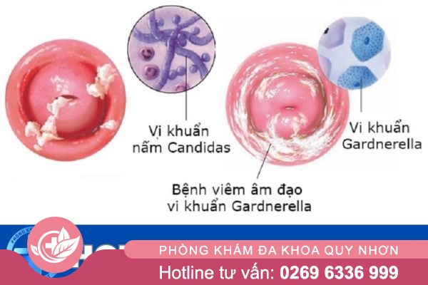 Viêm âm đạo là gì?