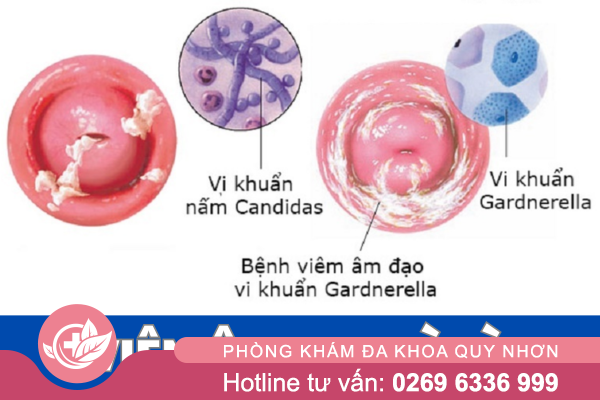 Viêm âm đạo là gì?