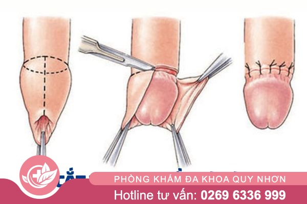 Cắt bao quy đầu là gì?