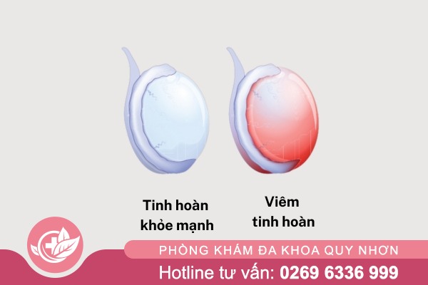 Chi phí điều trị viêm tinh hoàn ở Quy nhơn bao nhiêu?