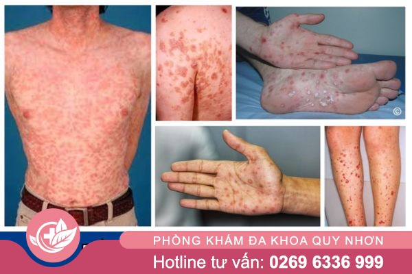 Hình ảnh bệnh giang mai 