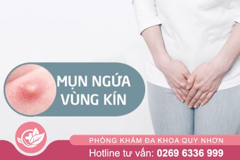 Nổi mụn ở mép vùng kín: Nguyên nhân và cách trị hiệu quả