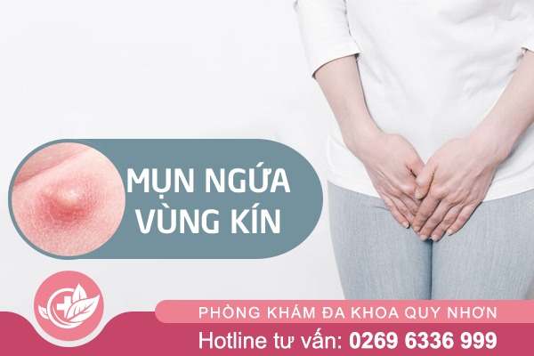 Nổi mụn ở mép vùng kín: Nguyên nhân và cách trị hiệu quả