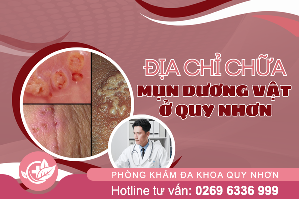 Địa chỉ chữa mụn dương vật ở Quy Nhơn