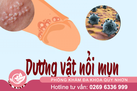 Địa chỉ chữa mụn dương vật ở Quy nhơn hiệu quả – uy tín