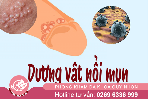 Địa chỉ chữa mụn dương vật ở Quy nhơn hiệu quả – uy tín