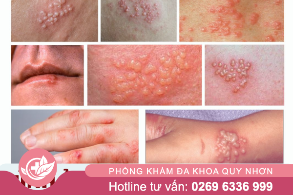 Hình ảnh mụn rộp sinh dục