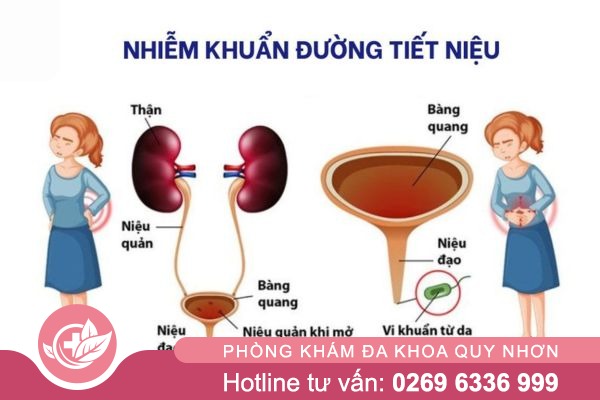 Tiểu buốt là gì?
