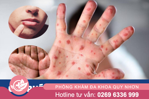 Chi phí chữa bệnh tình dục ở Quy Nhơn