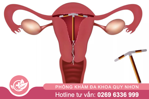 Tháo vòng tránh thai: Khi nào và cách thực hiện đúng