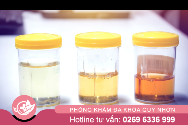 Tiểu ra máu là gì? Dấu hiệu nhận biết