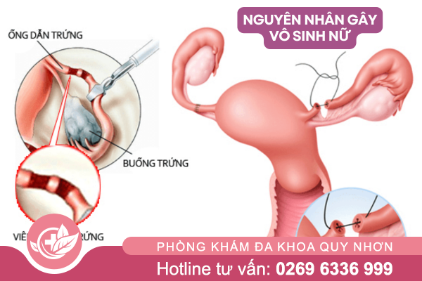 Nguyên nhân gây vô sinh nữ