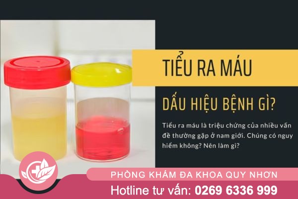 Tiểu ra máu là dấu hiệu của bệnh gì?