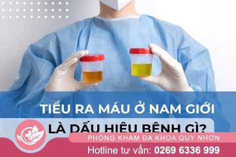 Tiểu ra máu ở nam: Dấu hiệu 5 bệnh nguy hiểm