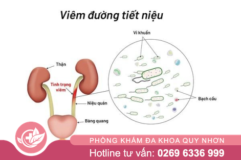 5 dấu hiệu viêm đường tiết niệu dễ nhận biết