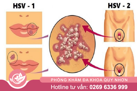 Mụn rộp sinh dục lây qua đường nào?