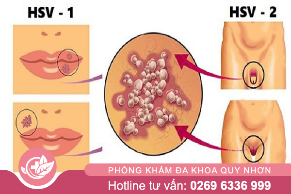 Mụn rộp sinh dục lây qua đường nào?