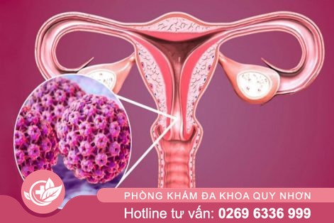 5 triệu chứng ung thư cổ tử cung dễ nhận ra
