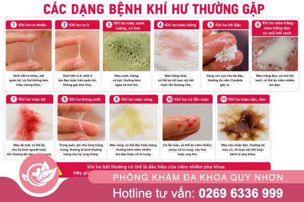 Bệnh khí hư là gì? Dấu hiệu nhận biết và khi nào cần đi khám