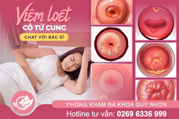 Viêm loét cổ tử cung là gì? Cách điều trị an toàn và nhanh khỏi
