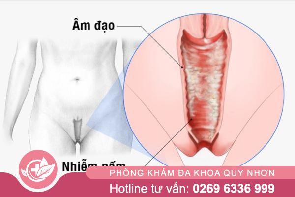 Nấm vùng kín là gì? Những điều chị em cần biết