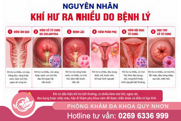 Khí hư ra nhiều bất thường – Cảnh báo viêm nhiễm phụ khoa