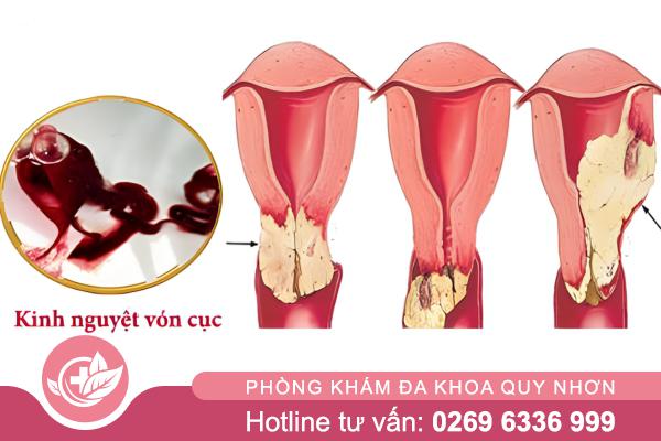 Kinh ra máu cục có bình thường không? Giải đáp từ chuyên gia