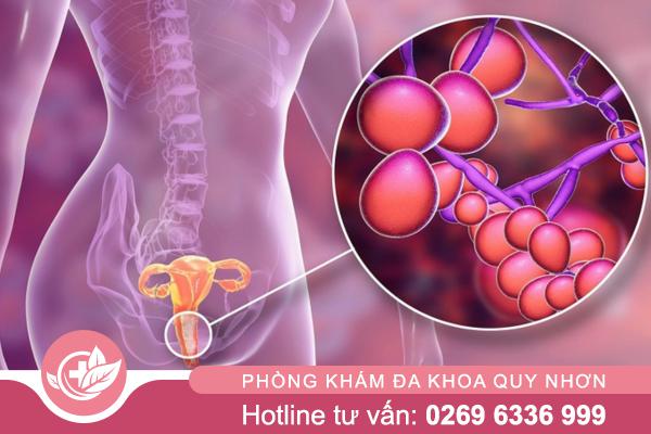 Hiểu đúng về nấm phụ khoa để điều trị hiệu quả