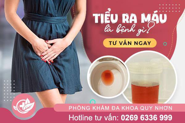 Tiểu ra máu là bệnh gì? Nguy hiểm không?
