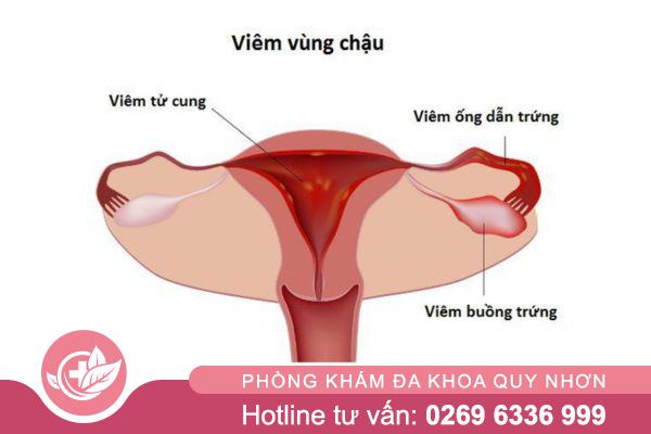 Viêm vùng chậu có thể gây vô sinh nếu không điều trị kịp thời