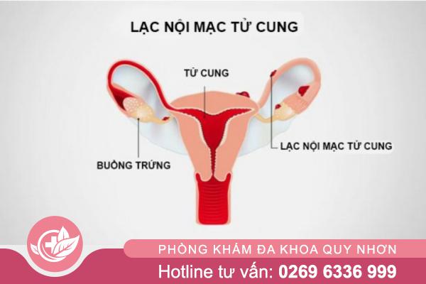Đau bụng kinh dữ dội – Cảnh báo lạc nội mạc tử cung