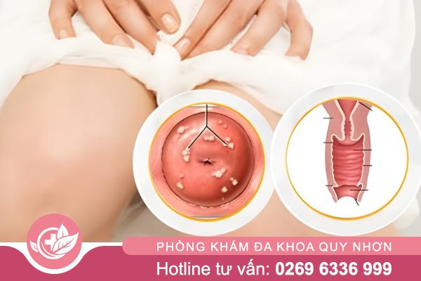 Nang Naboth cổ tử cung âm thầm nhưng có thể gây viêm nhiễm