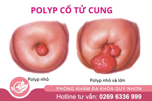 Polyp cổ tử cung và những biến chứng có thể gặp