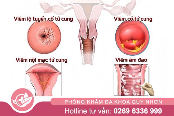 Viêm phụ khoa có nguy hiểm không? Khi nào cần đi khám?
