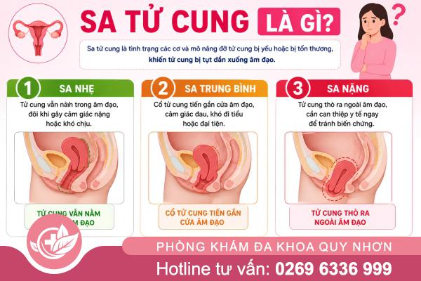 Hiện tượng sa tử cung – Điều chị em cần biết về sức khỏe sinh sản
