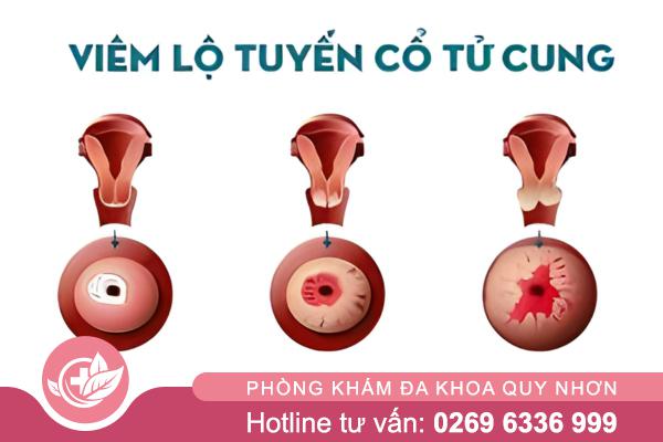 Viêm lộ tuyến cổ tử cung: Chẩn đoán sớm và điều trị hiệu quả